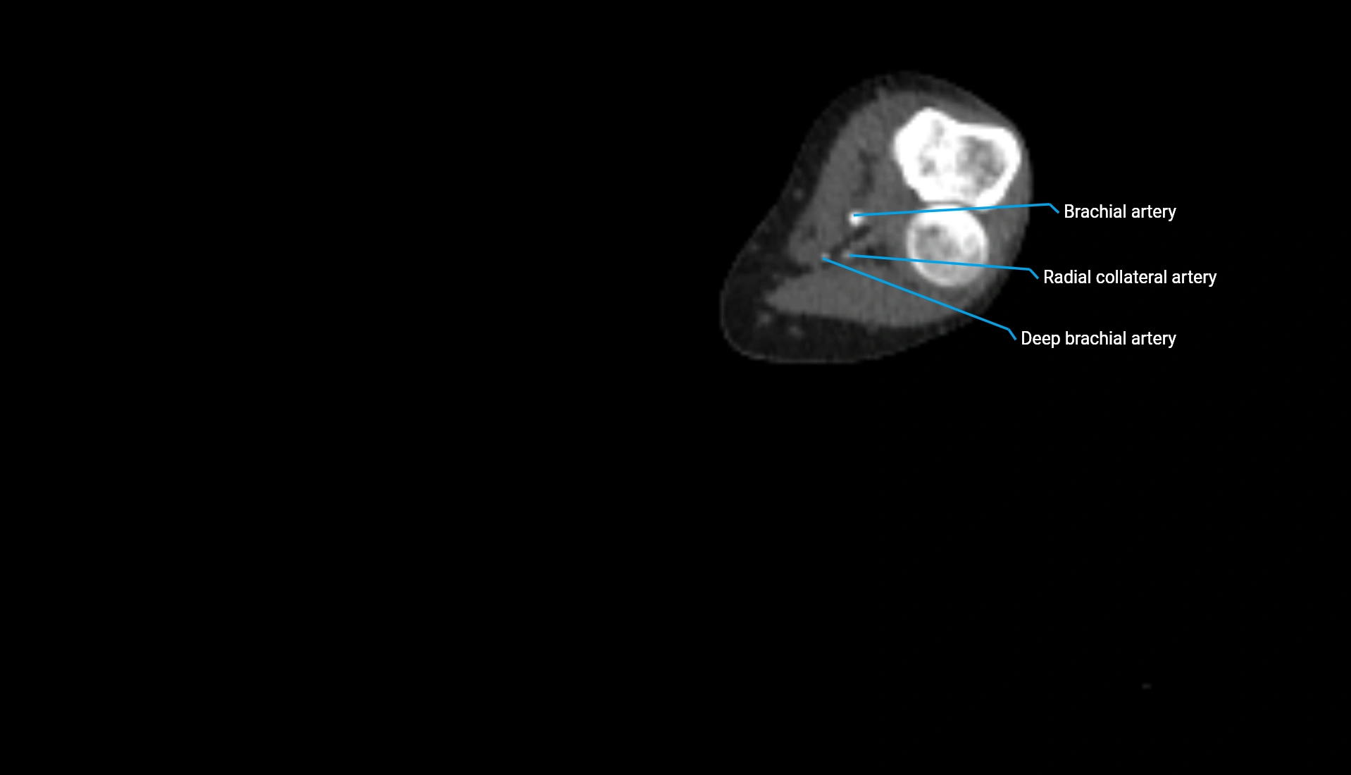 CTA upper limb axial cross sectional anatomy labelled image 182 (2).webp